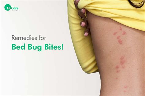 How To Get Rid Of Bed Bug Bites Marks