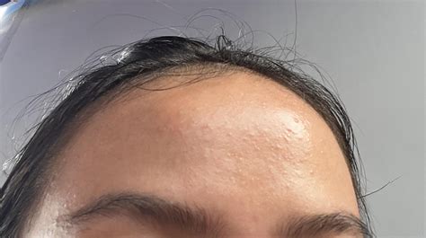 How To Get Rid Of Bumpy Texture On Forehead