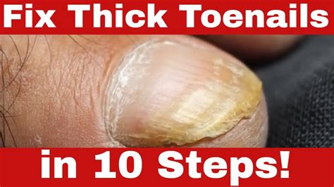How To Get Rid Of Bumpy Toenails