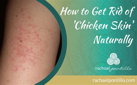 how to get rid of chicken bumps