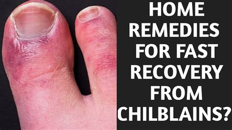 3 Ways to Get Rid of Chilblains wikiHow