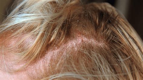 how to get rid of contact dermatitis fast on scalp