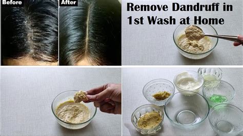 How To Get Rid Of Dandruff And Hair Fall Permanently At Home  A Comprehensive Guide