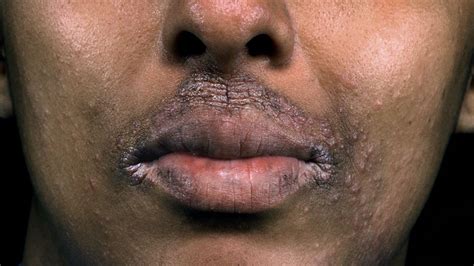 how to get rid of dark patches caused by eczema