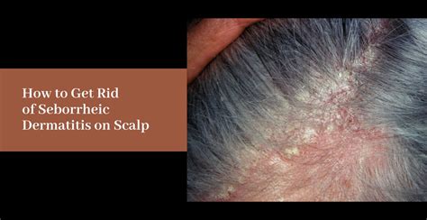 how to get rid of dermatitis on scalp