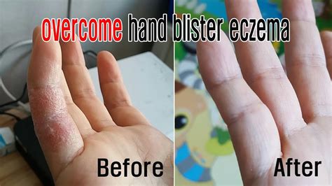 how to get rid of dermatitis on your hands