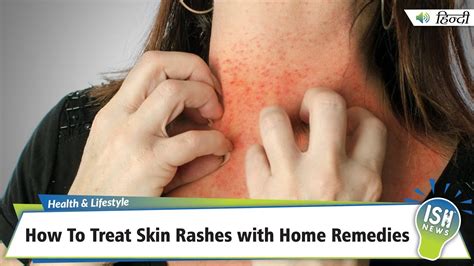 how to get rid of doxycycline rash
