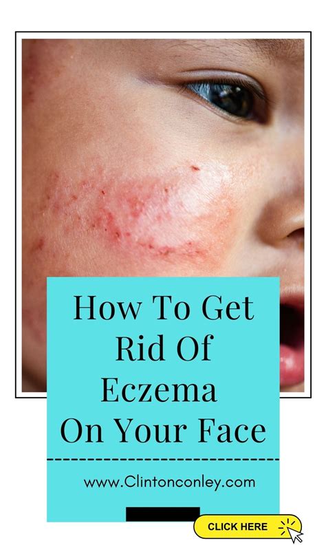 how to get rid of eczema hyperpigmentation reddit
