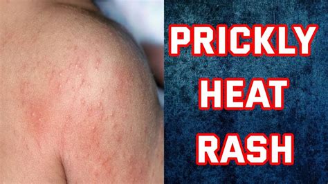 how to get rid of heat rash bumps quickly