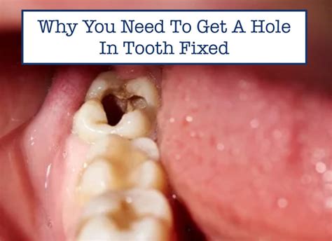 how to get rid of hole in tooth