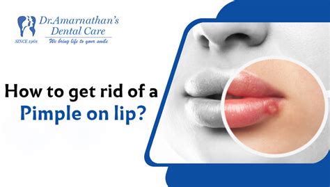 How To Get Rid Of Inflamed Pimple On Lip