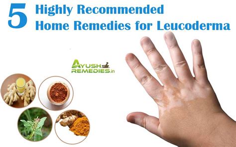 How To Get Rid Of Leucoderma