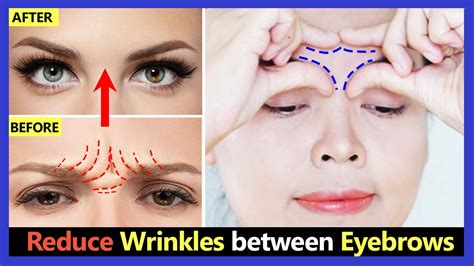 how to get rid of lines between eyebrows reddit
