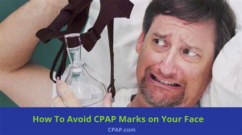 How To Get Rid Of Marks On Face From Cpap Mask