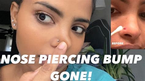 how to get rid of nose piercing bump fast overnight