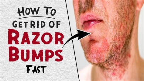 How To Get Rid Of Razor Burn Marks Fast