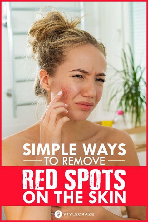 how to get rid of red patches on face reddit