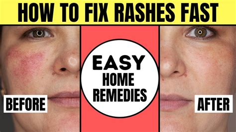 how to get rid of redness from rash
