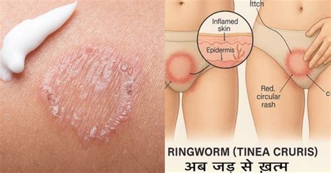 How To Get Rid Of Ringworm In Private Area