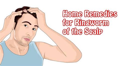 How To Get Rid Of Ringworm On Scalp At Home