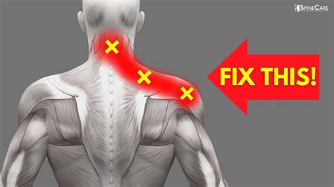 how to get rid of s trapped nerve in your neck