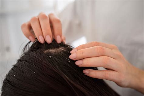 how to get rid of sebum on scalp