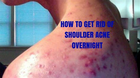 How to Get Rid of Shoulder Acne Overnight: Ultimate Guide