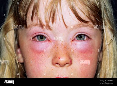 how to get rid of swelling from allergies
