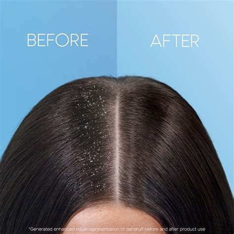 How To Get Rid Of Visible Scalp