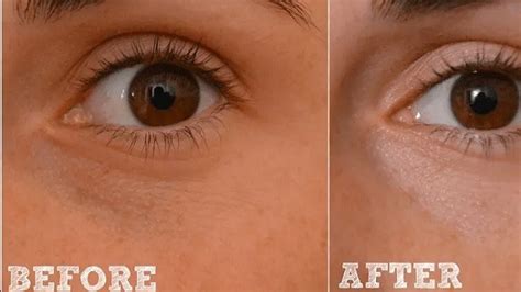 how to get rid of white patches under eyes