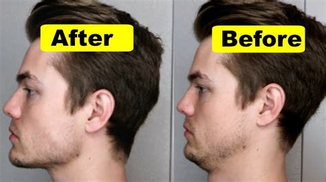 how to get your jawline back