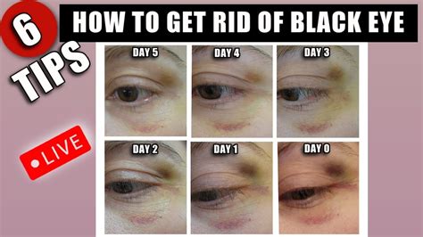 how to heal a black eye bruise fast