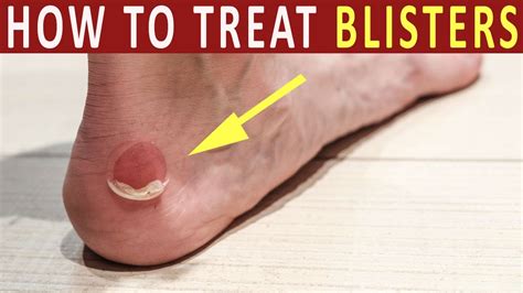 how to heal a busted blister