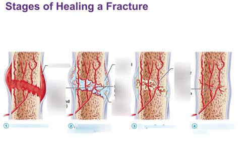how to heal fractures quickly