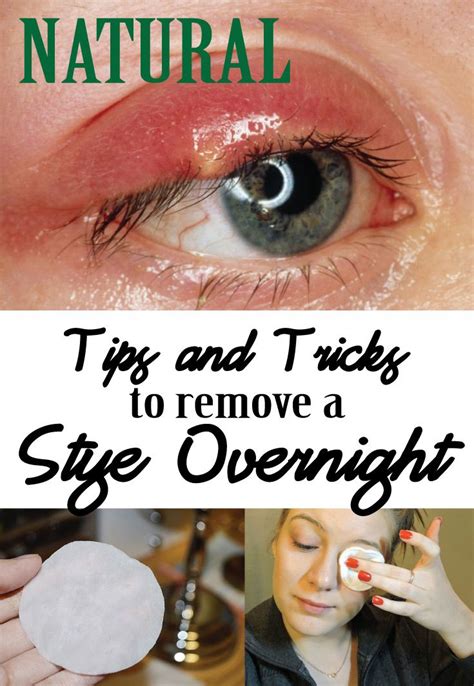 how to heal stye on eyelid