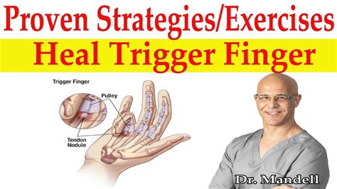 Heal Trigger Finger Naturally: Effective Treatment and Relief Methods
