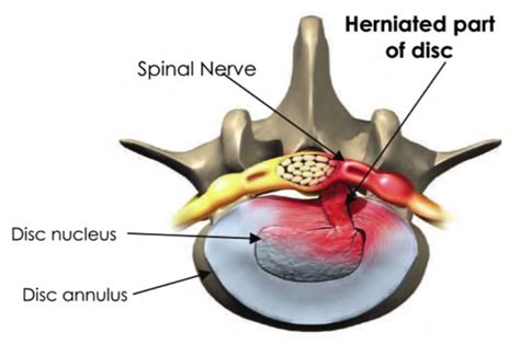 How To Help A Bulging Disc In Lower Back