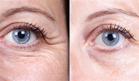 how to help crows feet