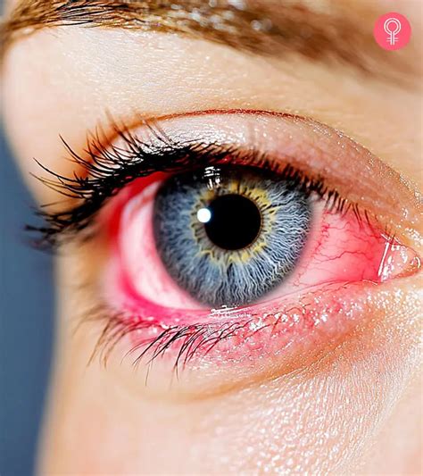 How To Help Flash Burn In Eyes