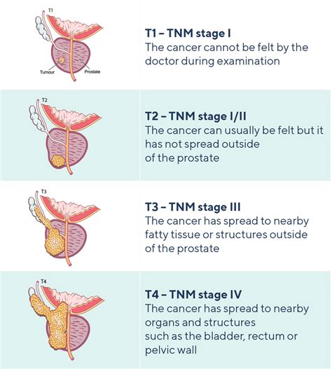 how to help someone with stage 4 prostate cancer