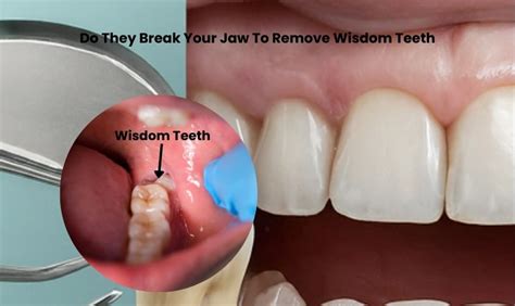 how to help wisdom teeth break through