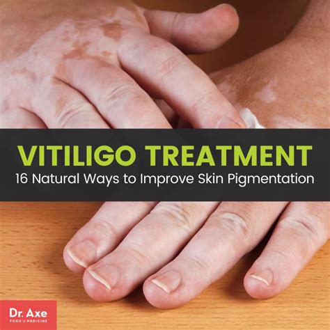 how to improve vitiligo naturally