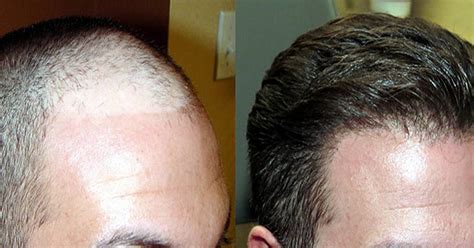 Perfect How To Increase Hair Density After Hair Transplant Hairstyles Inspiration