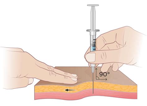 How To Insert Needle