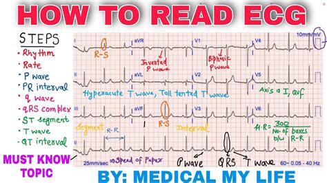 Mastering Cardiology: How to Interpret EKG Results Accurately