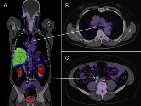 how to interpret psma pet scan results