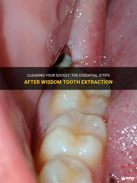 How To Keep Tooth Extraction Clean