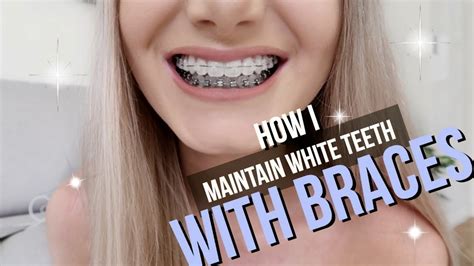 How To Keep White Teeth With Braces