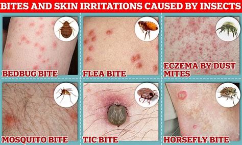 how to know if u got bit by a bed bug