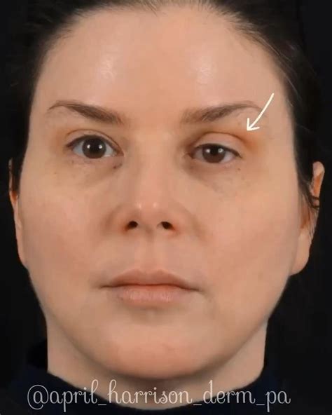 Unique How To Lift Droopy Eyelids With Botox For Short Hair